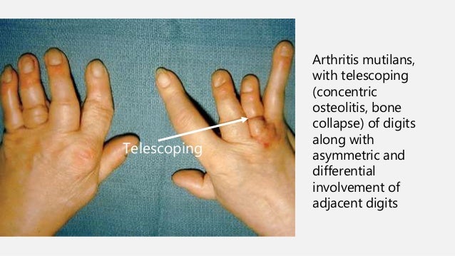 Psoaritic arthritis